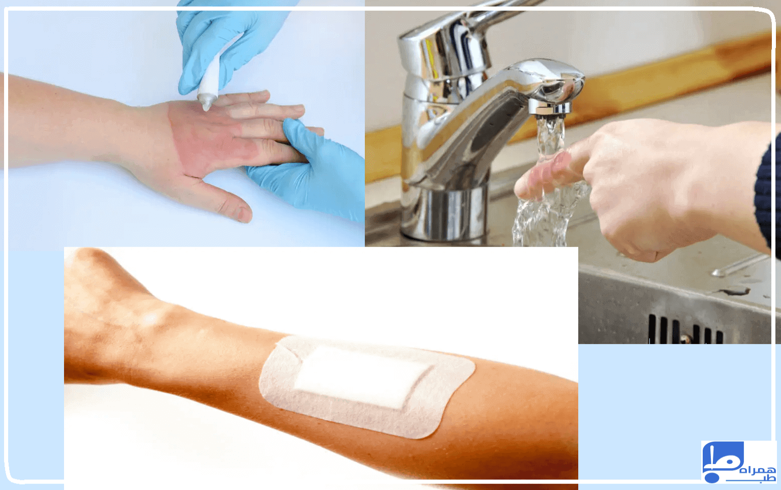 درمان سوختگی در خانه 